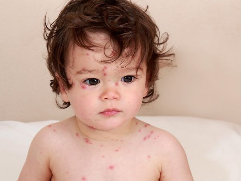 Sự khác nhau giữa sốt phát ban và sởi ở trẻ em 3