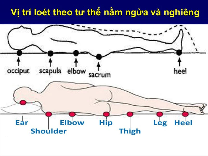 Sức khỏe: Phòng ngừa loét tì đè1