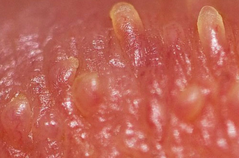 Sùi mào gà nữ gây ra bởi Human papilloma virus (HPV), còn được gọi là mụn cóc sinh dục