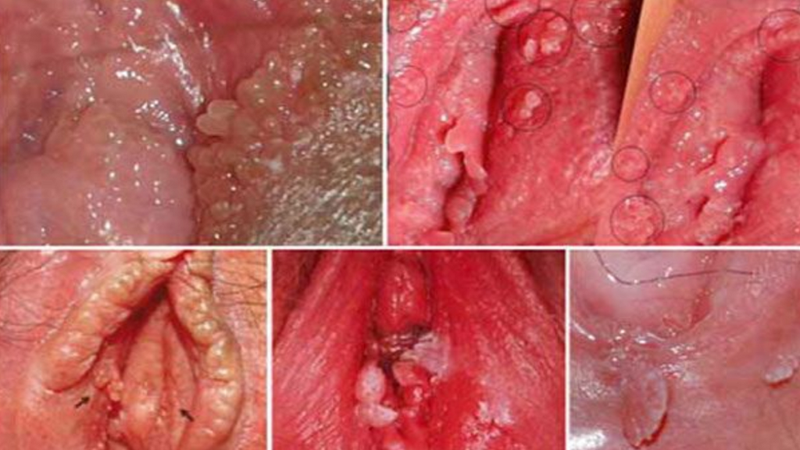 Phụ nữ mang thai mắc bệnh sùi mào gà có thể truyền bệnh cho con khi sinh qua đường âm đạo