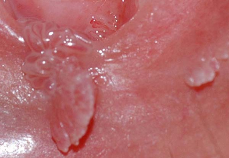 Hầu hết sùi mào gà nữ không ngứa hoặc không đau, nhưng chúng có thể dễ rách và chảy máu khi quan hệ tình dục