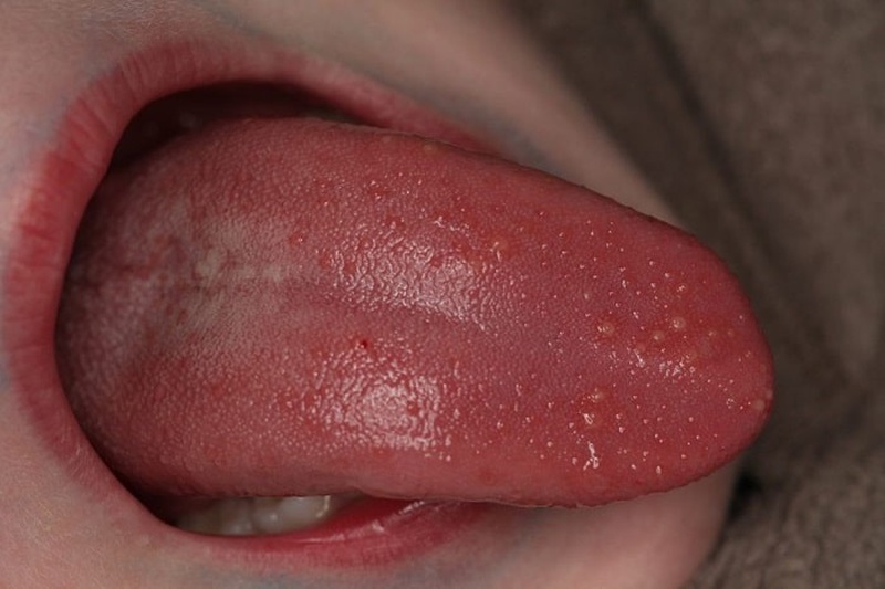 [Góc giải đáp] Sùi mào gà tự đào thải được hay không? 2