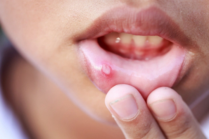 Cách phòng tránh bệnh nhiệt miệng