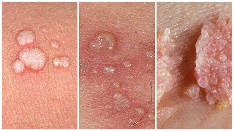 Sùi mào gà ủ bệnh bao lâu và dấu hiệu nhận biết 1