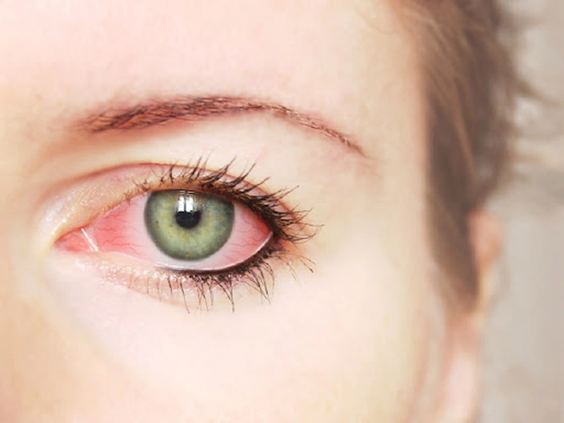 Sưng khóe mắt: Hiểu đúng nguyên nhân và cách điều trị hiệu quả