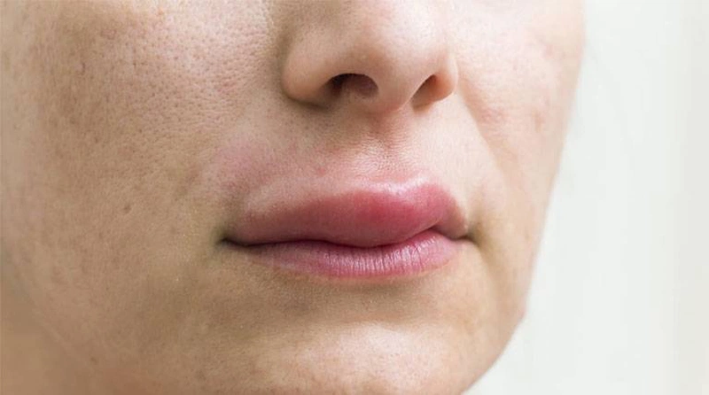 Sưng môi trên khi ngủ dậy là bệnh gì? Có nguy hiểm không? 1