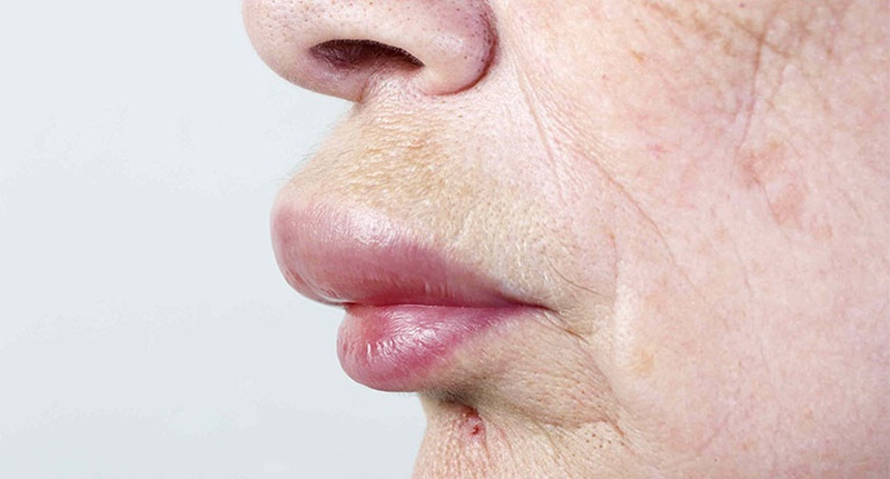 Sưng môi trên khi ngủ dậy là bệnh gì? Có nguy hiểm không? 2