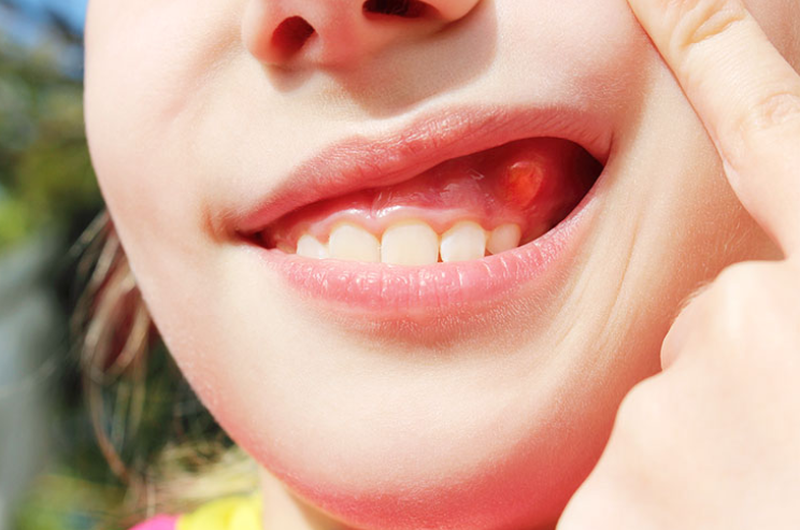 Nguyên nhân và cách điều trị bệnh viêm lợi