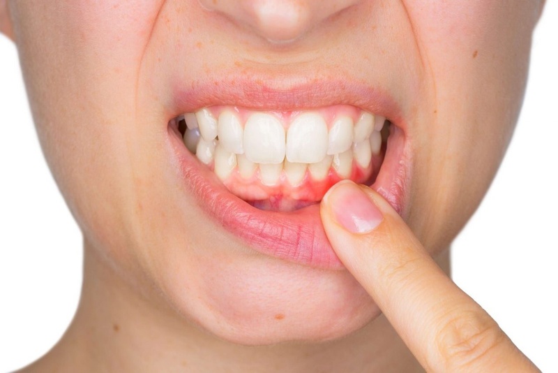 Sưng nướu răng có mủ: Nguyên nhân và cách điều trị 1