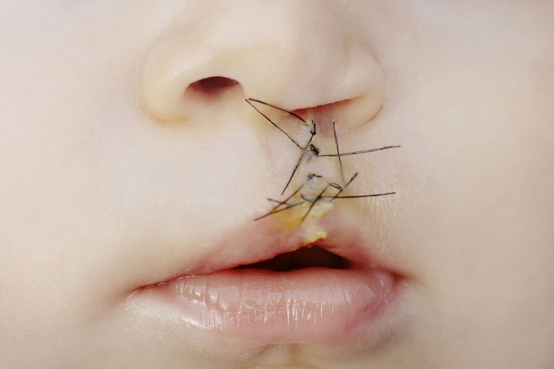 Những điều cần biết về sứt môi và hở hàm ếch ở trẻ 1