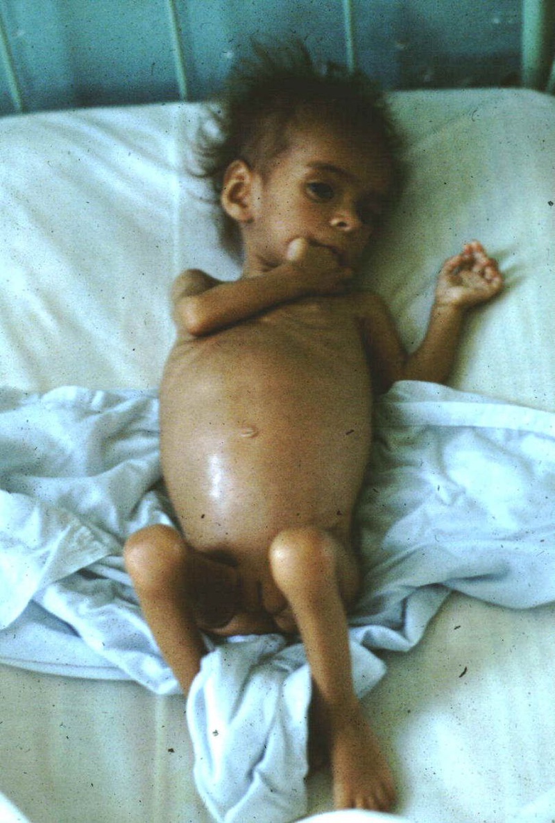 Suy dinh dưỡng kwashiorkor ở trẻ- Phòng suy dinh dưỡng kwashiorkor như thế nào là đúng 1