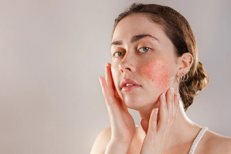 Tác hại của stress đối với làn da và cách khắc phục 1