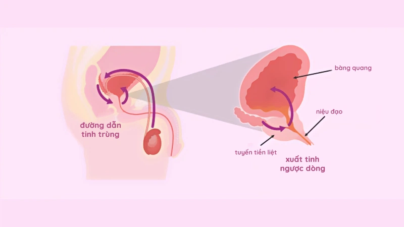 Tác hại xuất tinh ngược dòng. Nguyên nhân gây nên xuất tinh ngược dòng ai cũng nên biết 2