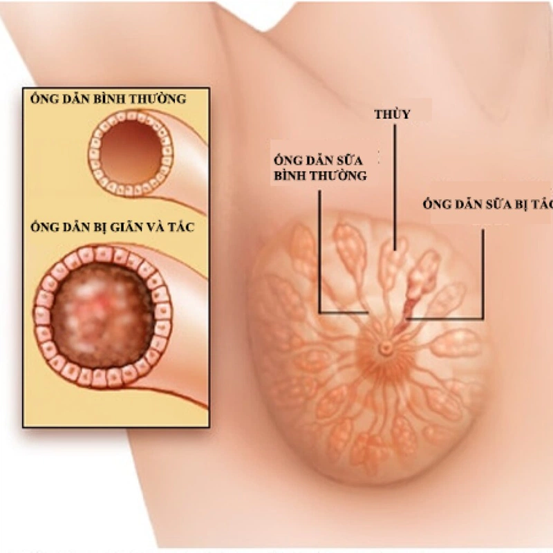 Viêm tuyến vú do bị tắc tia sữa