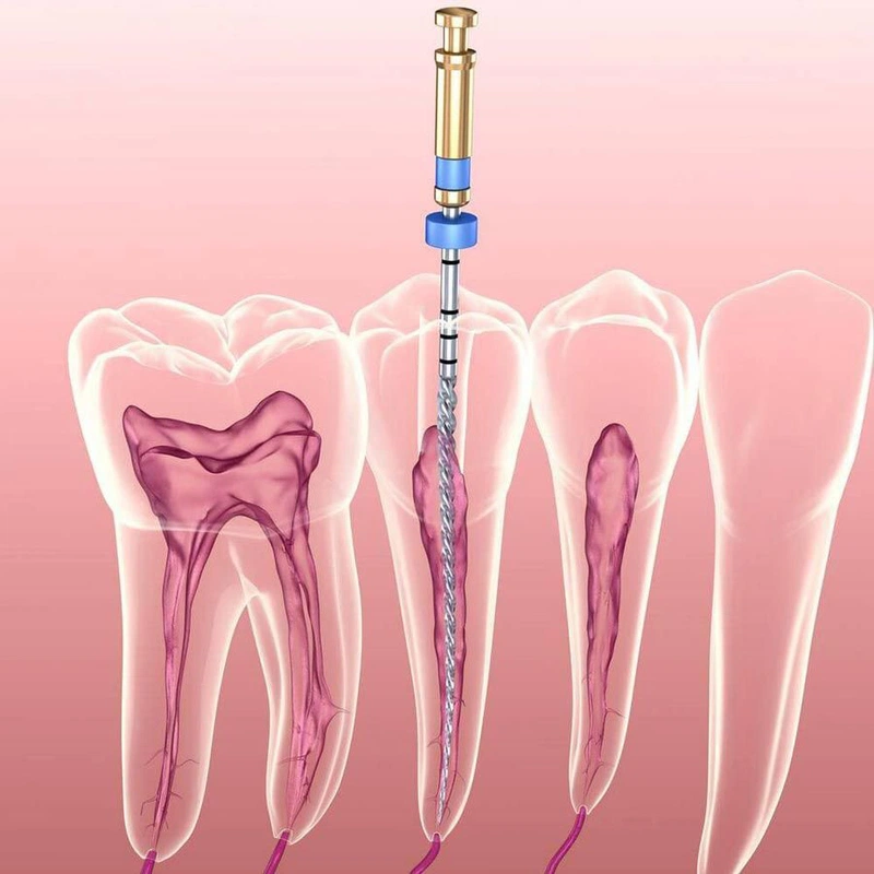 Lấy tủy răng là gì, vì sao chữa viêm tủy răng xong vẫn đau nhức