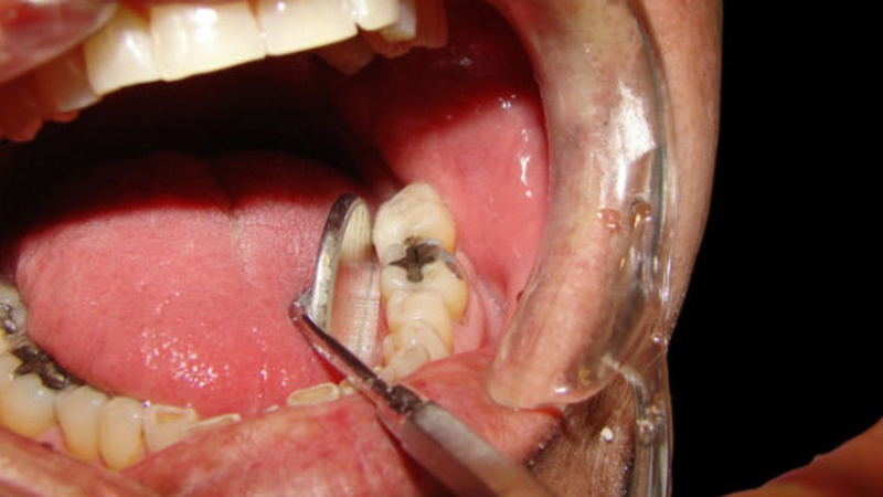 Những triệu chứng có thể xảy ra sau khi điều trị viêm tủy răng.