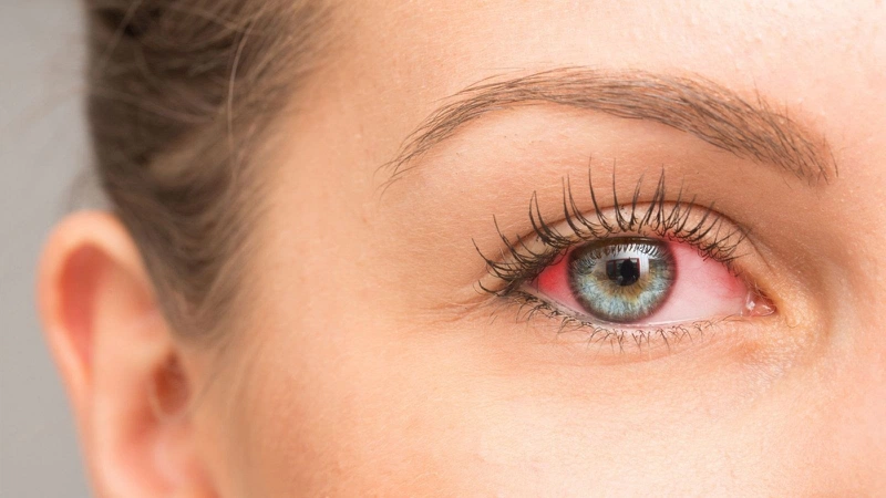 Tại sao đeo lens bị đỏ mắt?2
