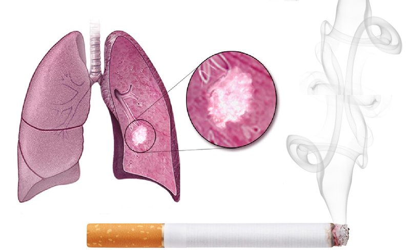 người hút thuốc lá có khả năng bị ung thư phổi cao hơn bình thường