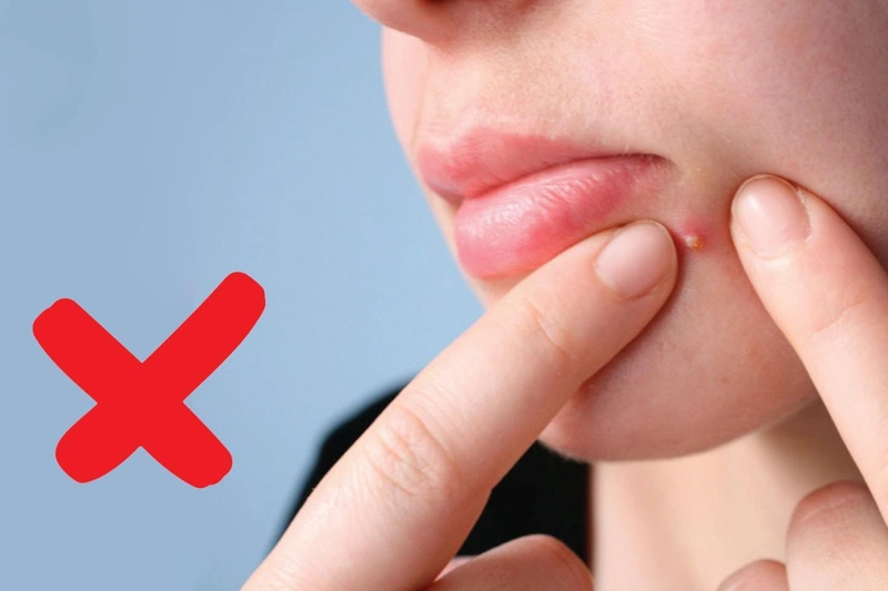 Tại sao mụn trứng cá lại có mùi hôi?4