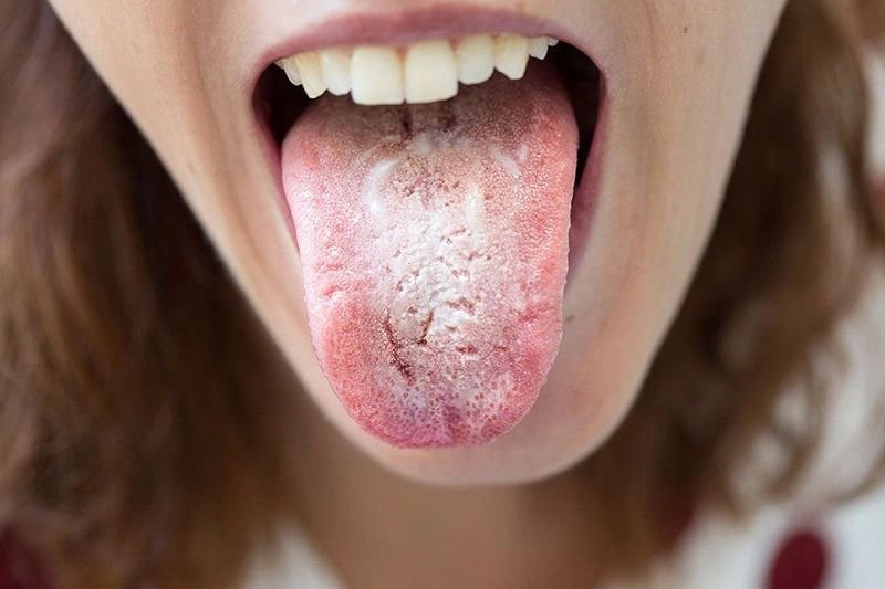 Tại sao nấm họng gây ho? Nguyên nhân và cách điều trị ra sao 1