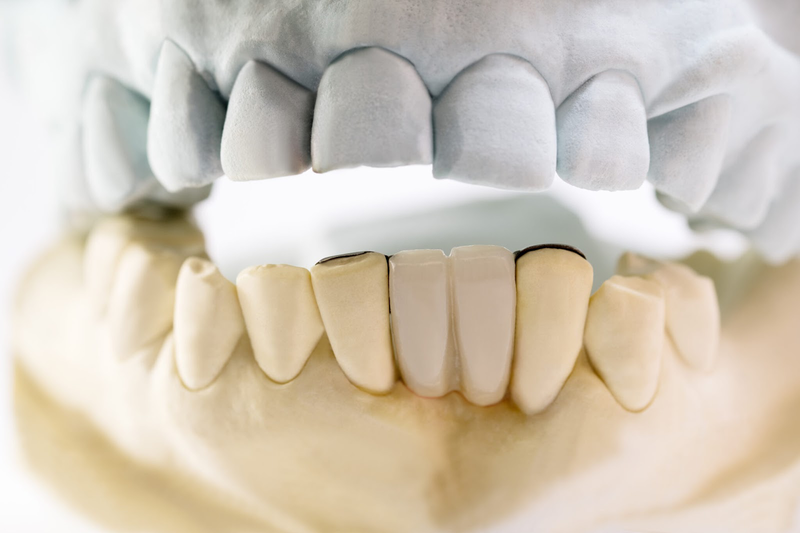 Tại sao niềng răng bị hóp má và cách khắc phục 2