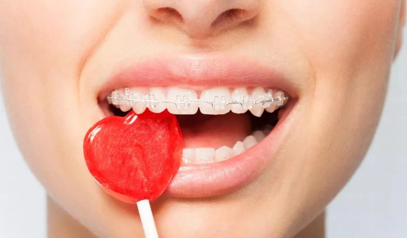 Tại sao niềng răng lại bị hóp má và cách khắc phục hiệu quả? 2