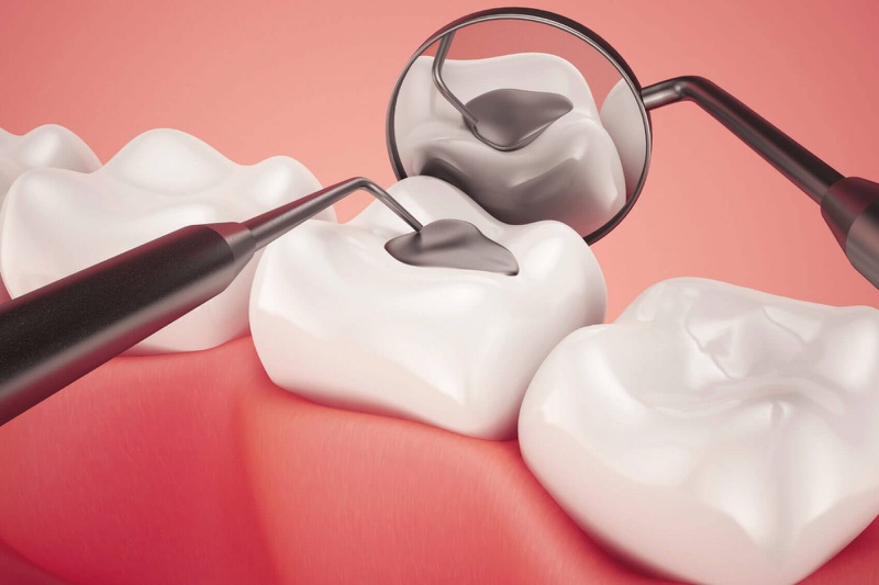 Tại sao răng ê buốt sau khi trám? Cách khắc phục như thế nào? 3