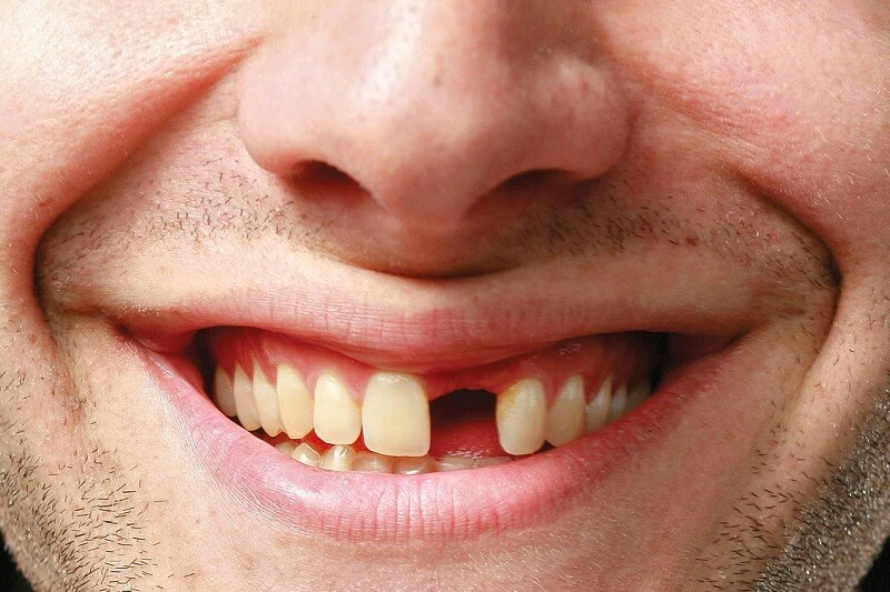 Tại sao răng vĩnh viễn bị lung lay? Khắc phục như thế nào? 2