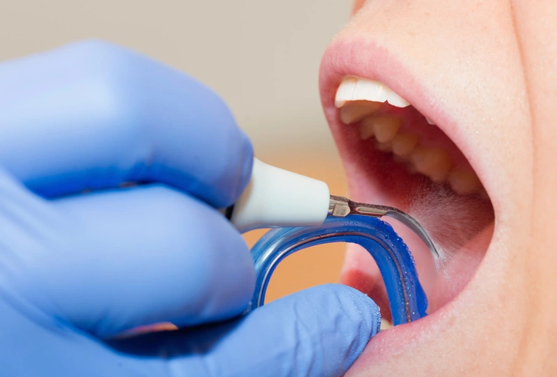 Tại sao răng vĩnh viễn bị lung lay? Khắc phục như thế nào? 3