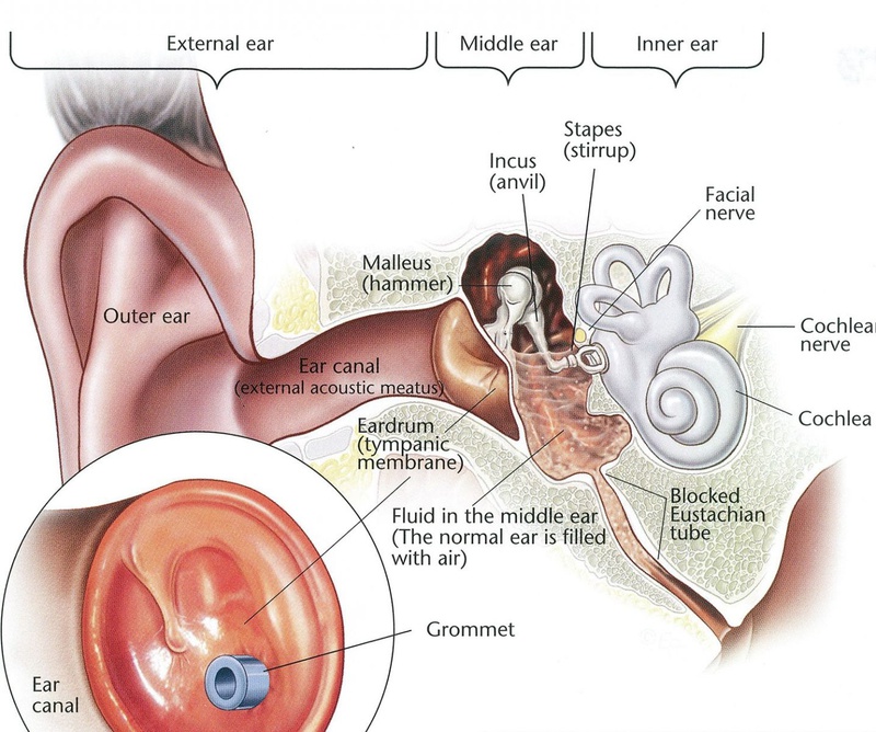 Tại sao viêm tai giữa phải đặt ống?1