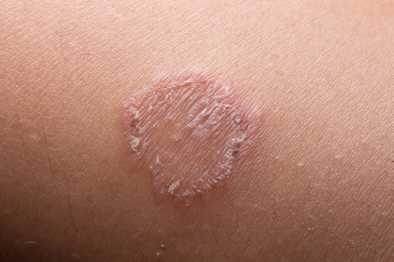 Tắm lá gì để trị hắc lào nhanh chóng và hiệu quả 1
