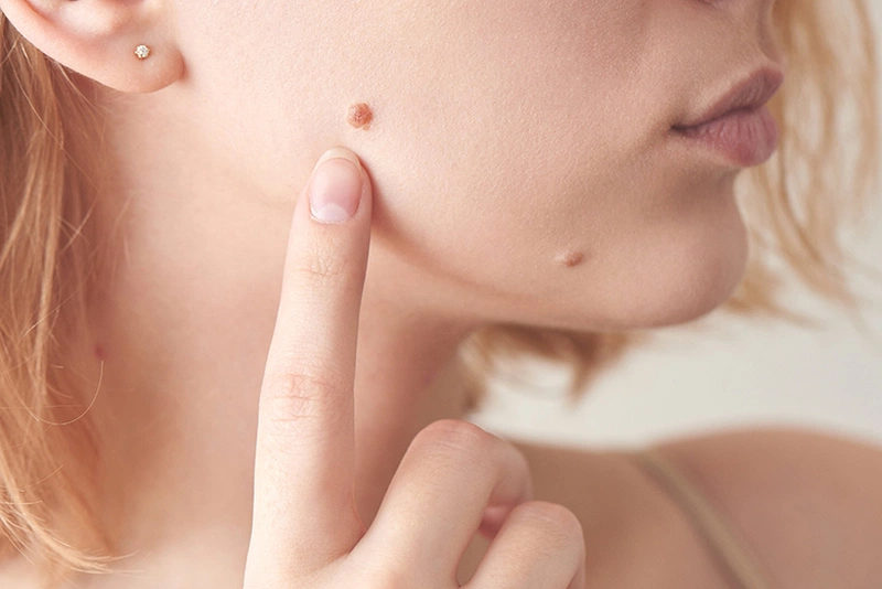 Tàn nhang có phải nốt ruồi không? Những điểm khác biệt của tàn nhang và nốt ruồi 2