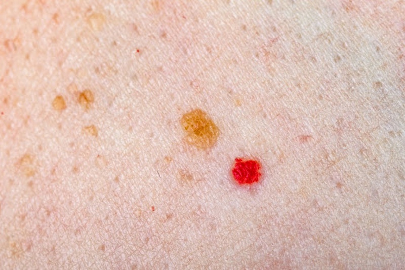 Tàn nhang đỏ và những điều bạn cần phải biết