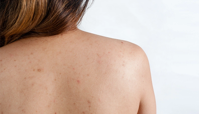 Tàn nhang trên lưng và cách điều trị hiệu quả nhất 1