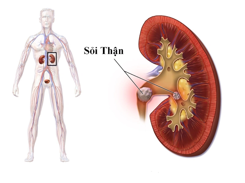 tán sỏi thận