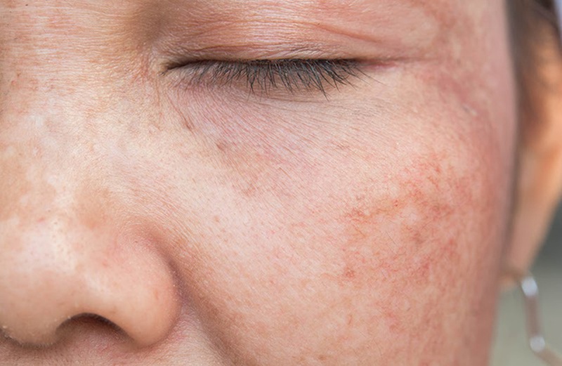 Tăng sắc tố da là gì có điều trị được không?