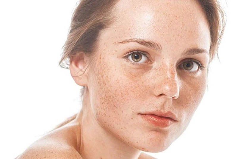 Tăng sắc tố da là gì có điều trị được không?