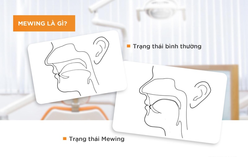 Tập luyện kỹ thuật Mewing có giúp mũi nhỏ lại không hay chỉ là ngộ nhận?2