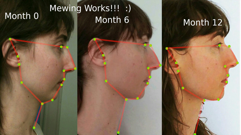 Tập Mewing có giúp mũi cao không hay chỉ là lời đồn?2