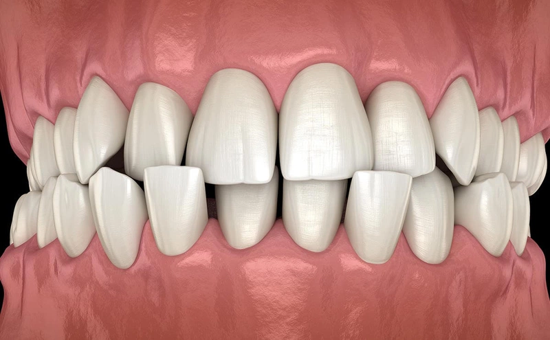 Tập Mewing có giúp mũi cao không hay chỉ là lời đồn?3
