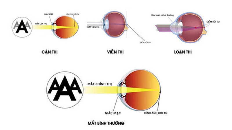 Tật khúc xạ cận thị có di truyền không? 1