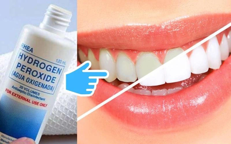 Oxy già là dung dịch sát khuẩn giúp tẩy trắng răng
