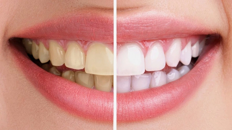 Tẩy trắng răng có bị vàng lại hay không?