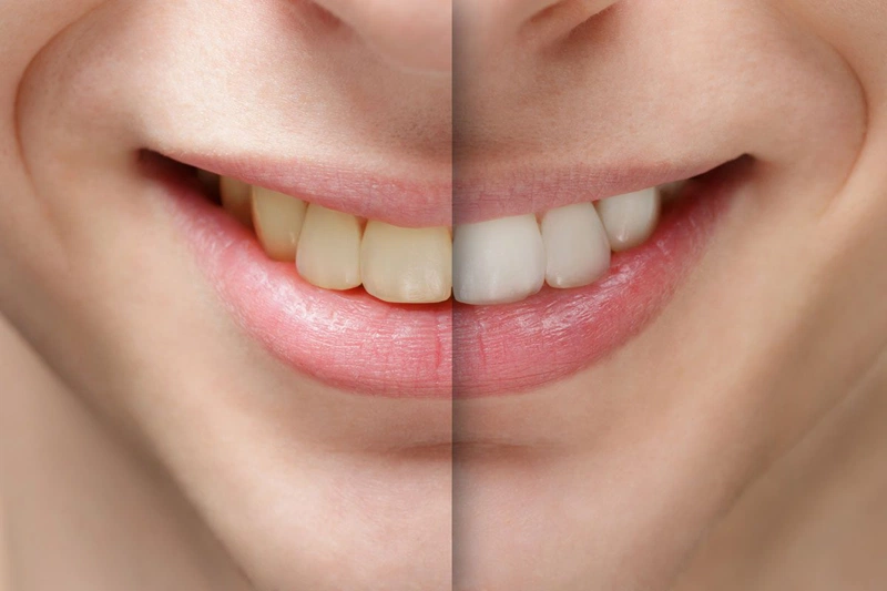 Duy trì màu răng sau khi tẩy trắng từ 7-10 ngày