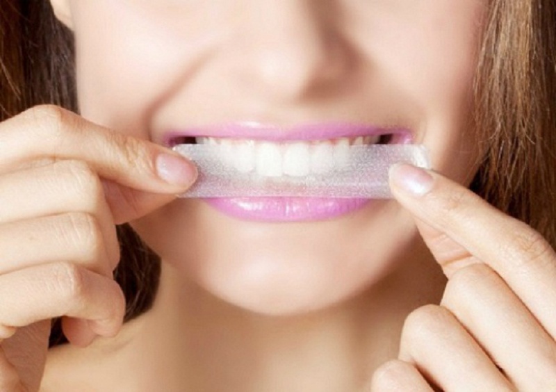 Răng không đều màu là do nha sĩ tẩy trắng sai kỹ thuật