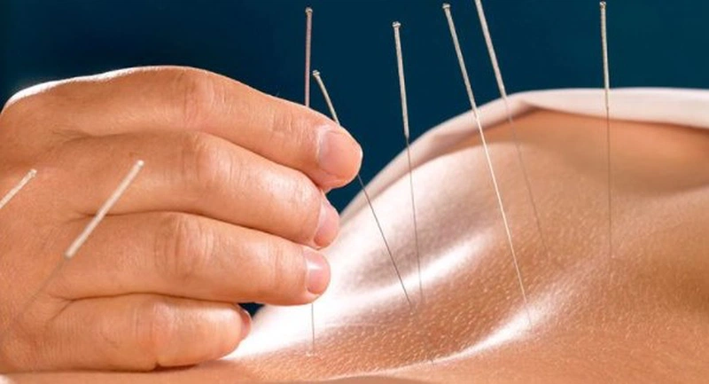 Châm cứu huyệt quyết âm nhu cần thực hiện bởi chuyên gia hoặc bác sĩ có tay nghề để tránh rủi ro