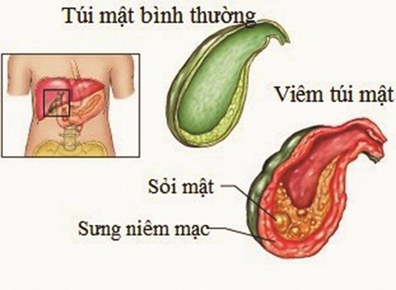 thắc mắc bị sỏi mật có uống được tinh bột nghệ không 1