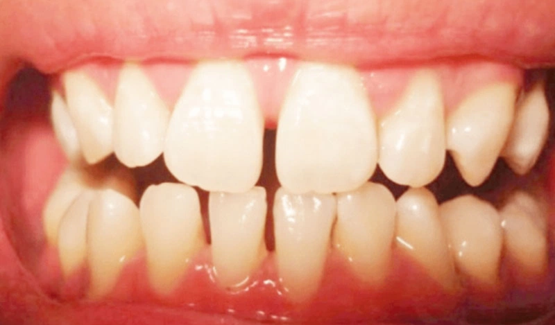 Tác hại của xỉa răng: gây thưa răng