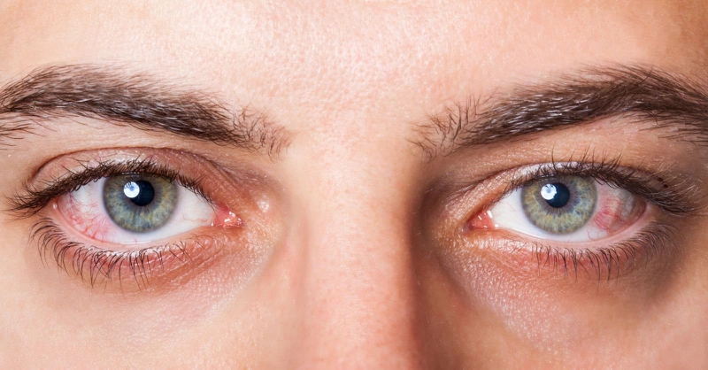 Thắc mắc: Đau mắt đỏ rửa nước muối có hiệu quả?1