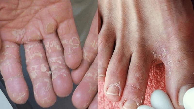 Thắc mắc: Hà ăn chân là bệnh gì? Làm sao chữa trị? 2